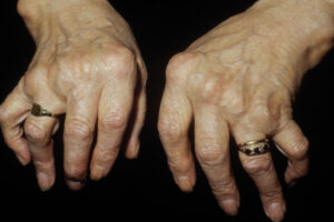 Arthrite: on vous dit tout dans notre dossier complet 1 polyarthrite avancée