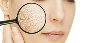 peau sèche, peau sèche, visage Namaste Naturo - Coaching Santé et Bien-Être